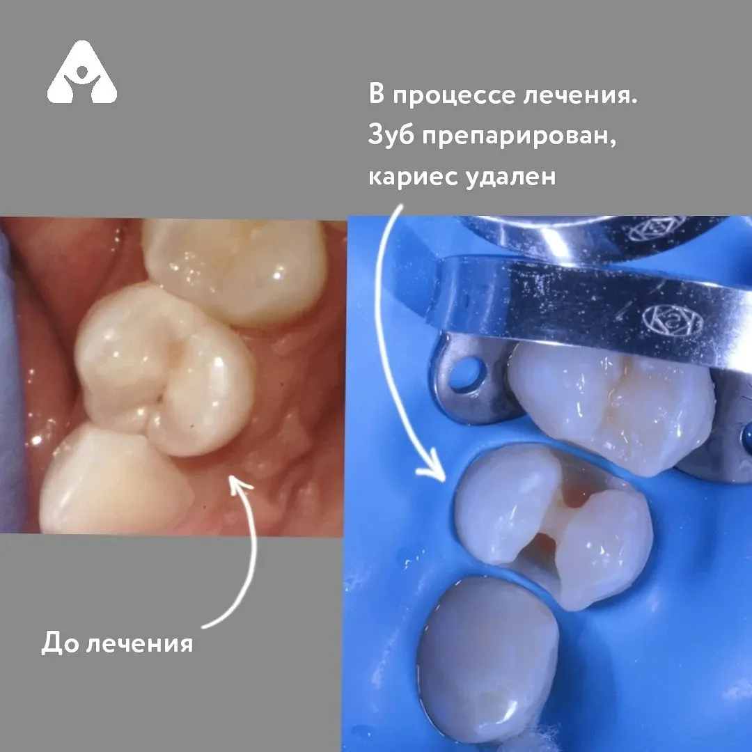 Лечение кариеса — до