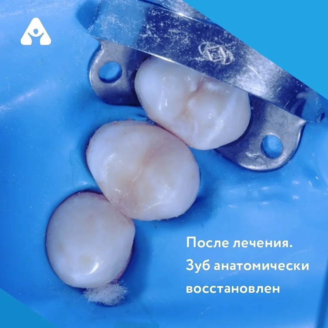 Лечение кариеса — после