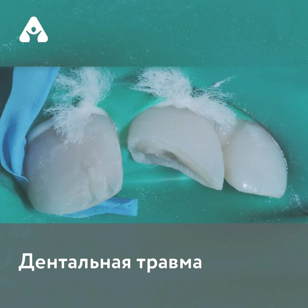 Дентальная травма — до