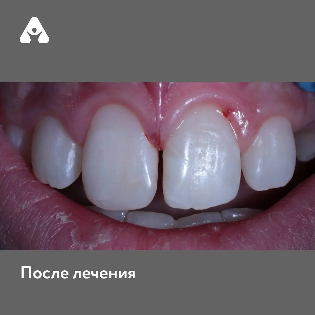 Дентальная травма — после