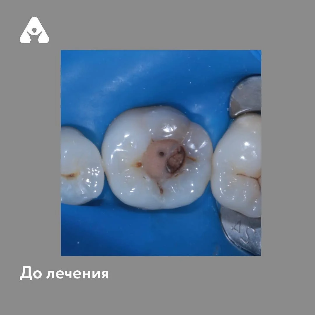 Лечение глубокого кариеса — до