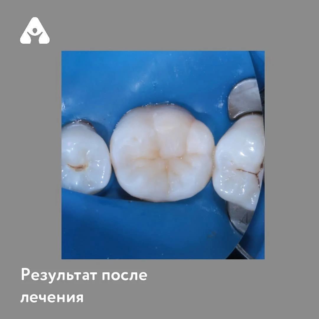 Лечение глубокого кариеса — после