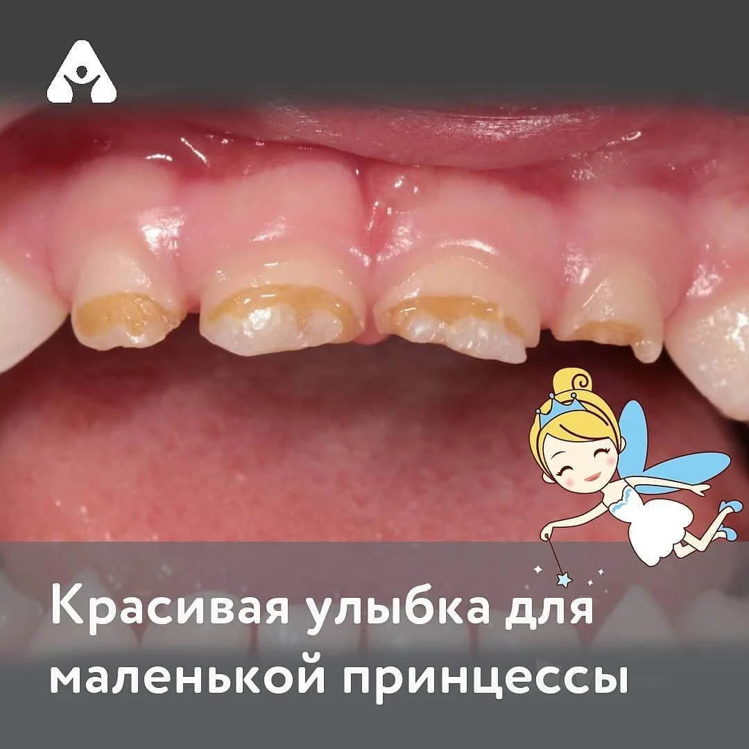 Красивая улыбка для принцессы — до