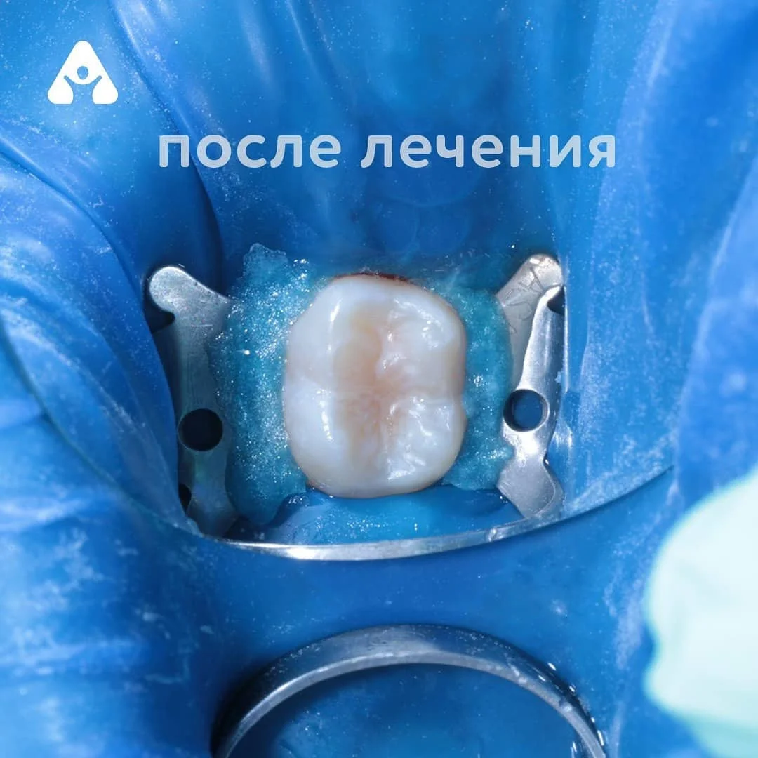 Герметизация фиссур — после
