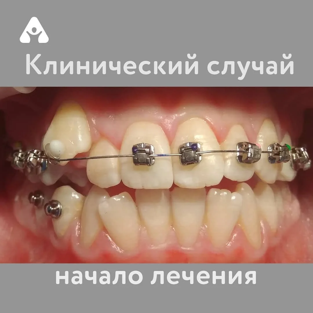 Установка брекетов — до