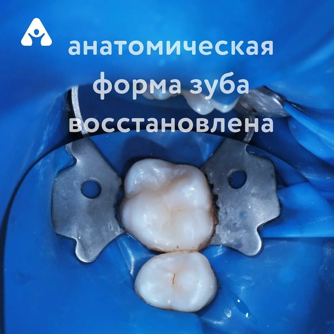 Замена старой пломбы — после