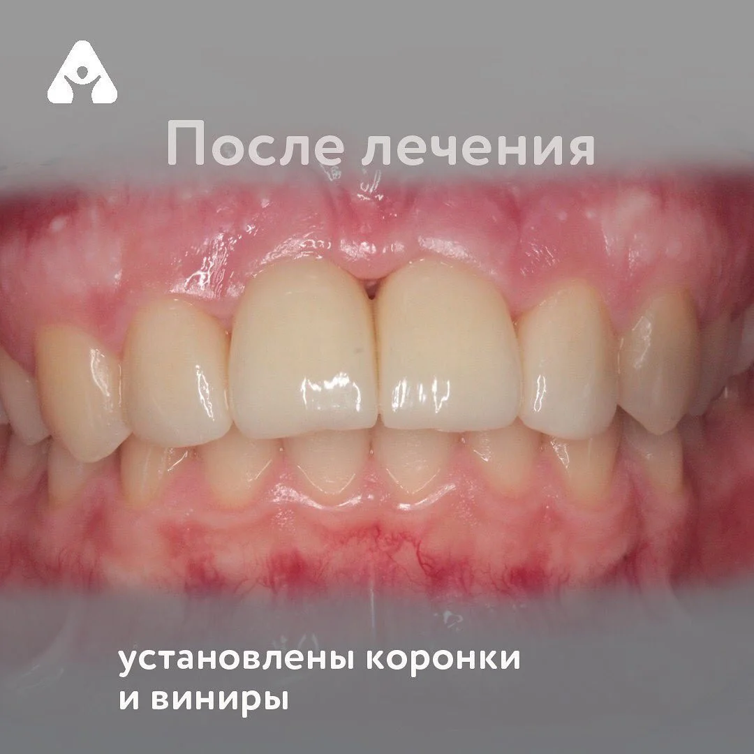 Имплантация зубов — после