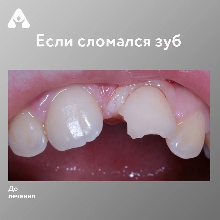 Если сломался зуб — до