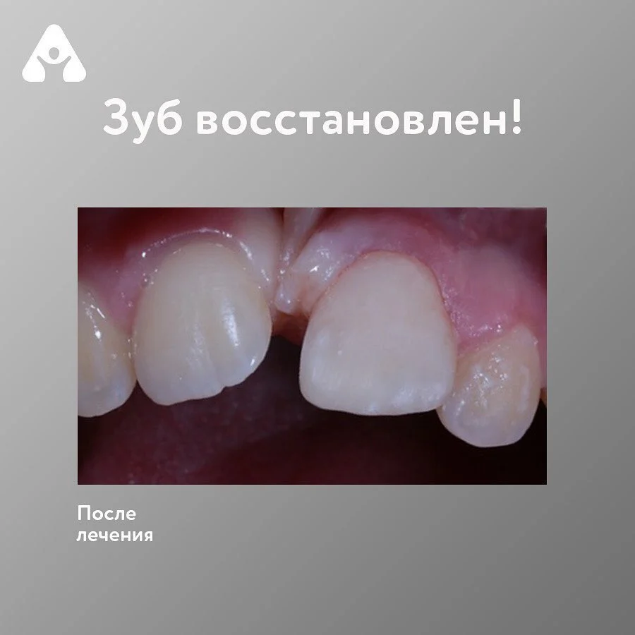 Если сломался зуб — после