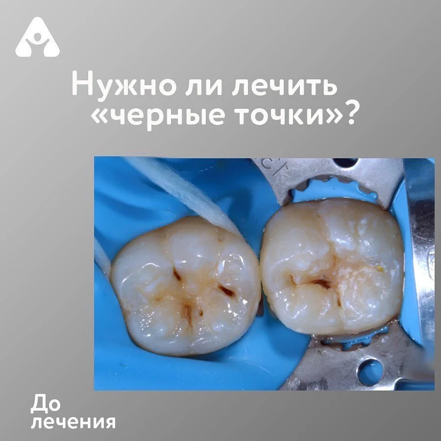 Чёрные точки на зубах — до