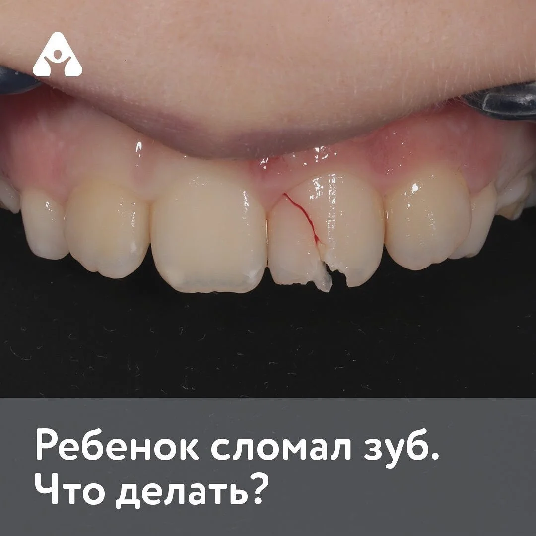 Восстановление зуба — до